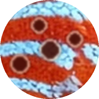 Hole-in-the-Head (HLLE) close-up
